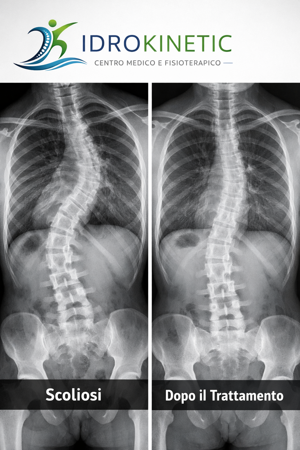 Confronto radiografico scoliosi prima e dopo il trattamento di rieducazione posturale presso Idrokinetic